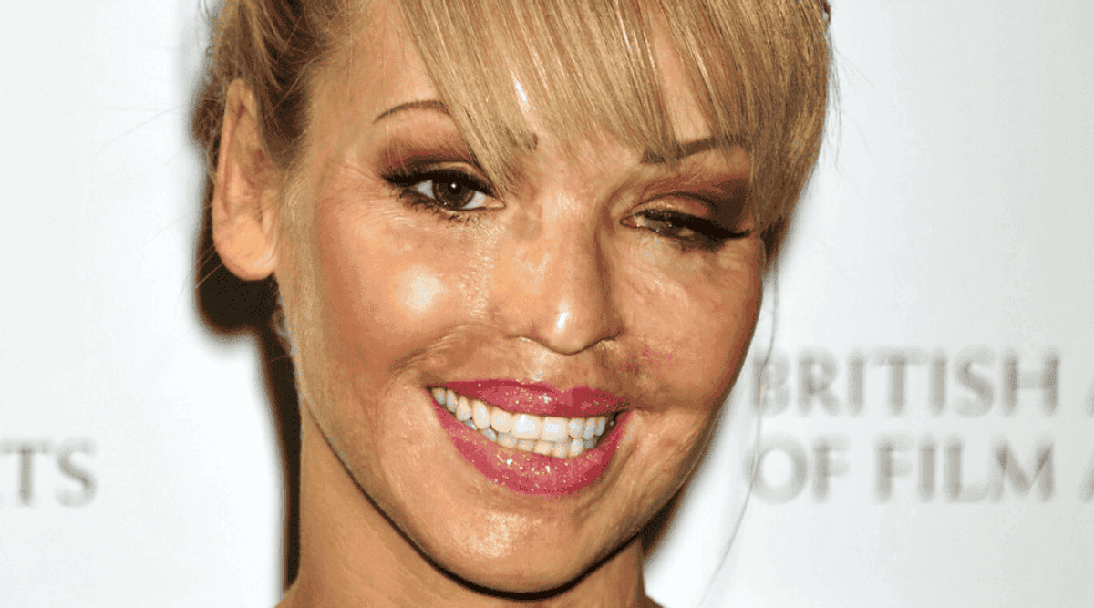 Katie Piper Została Oblana Kwasem Przeszła Już 400 Operacji Plastycznych 