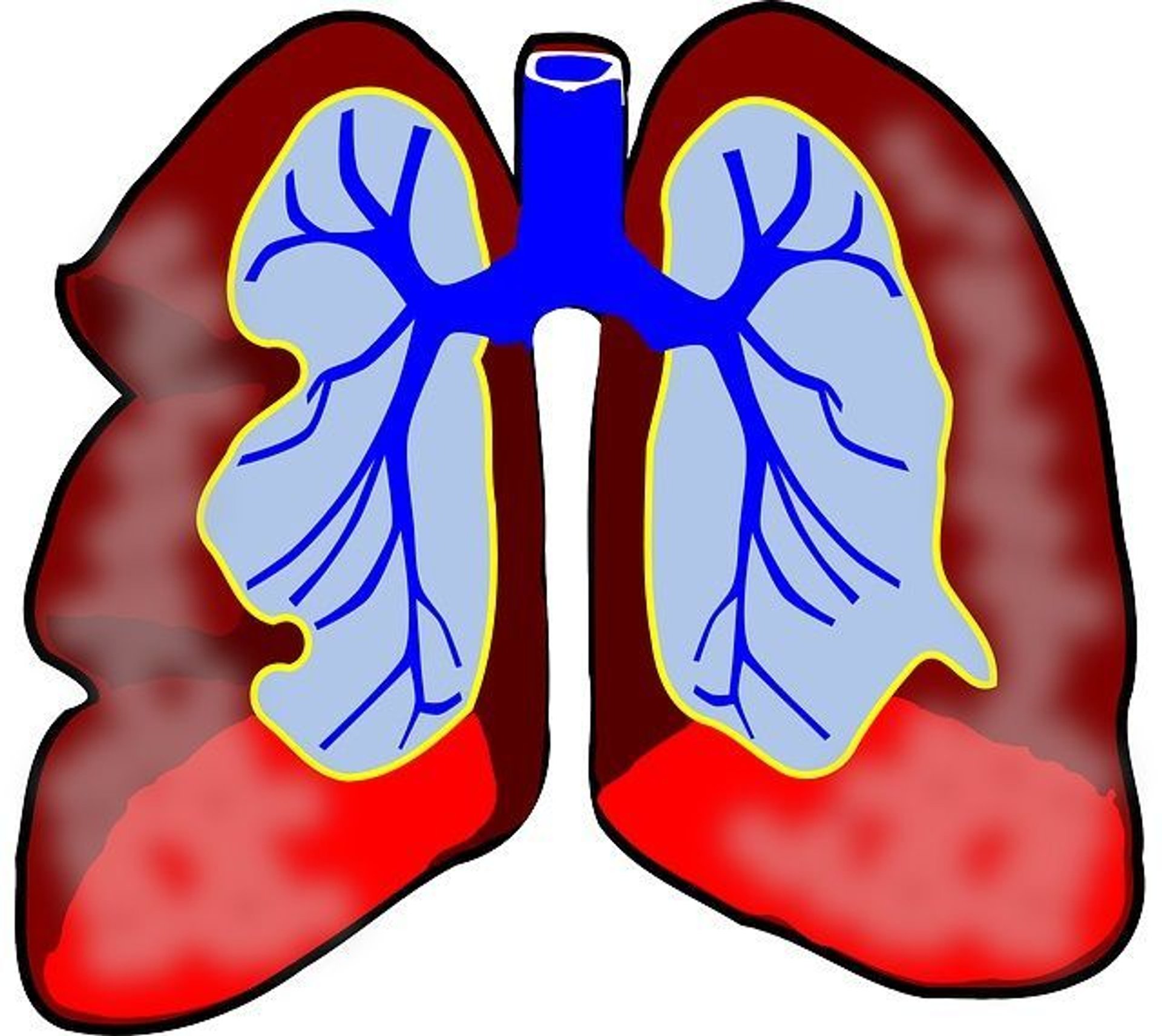Astma wysiłkowa – objawy i leczenie