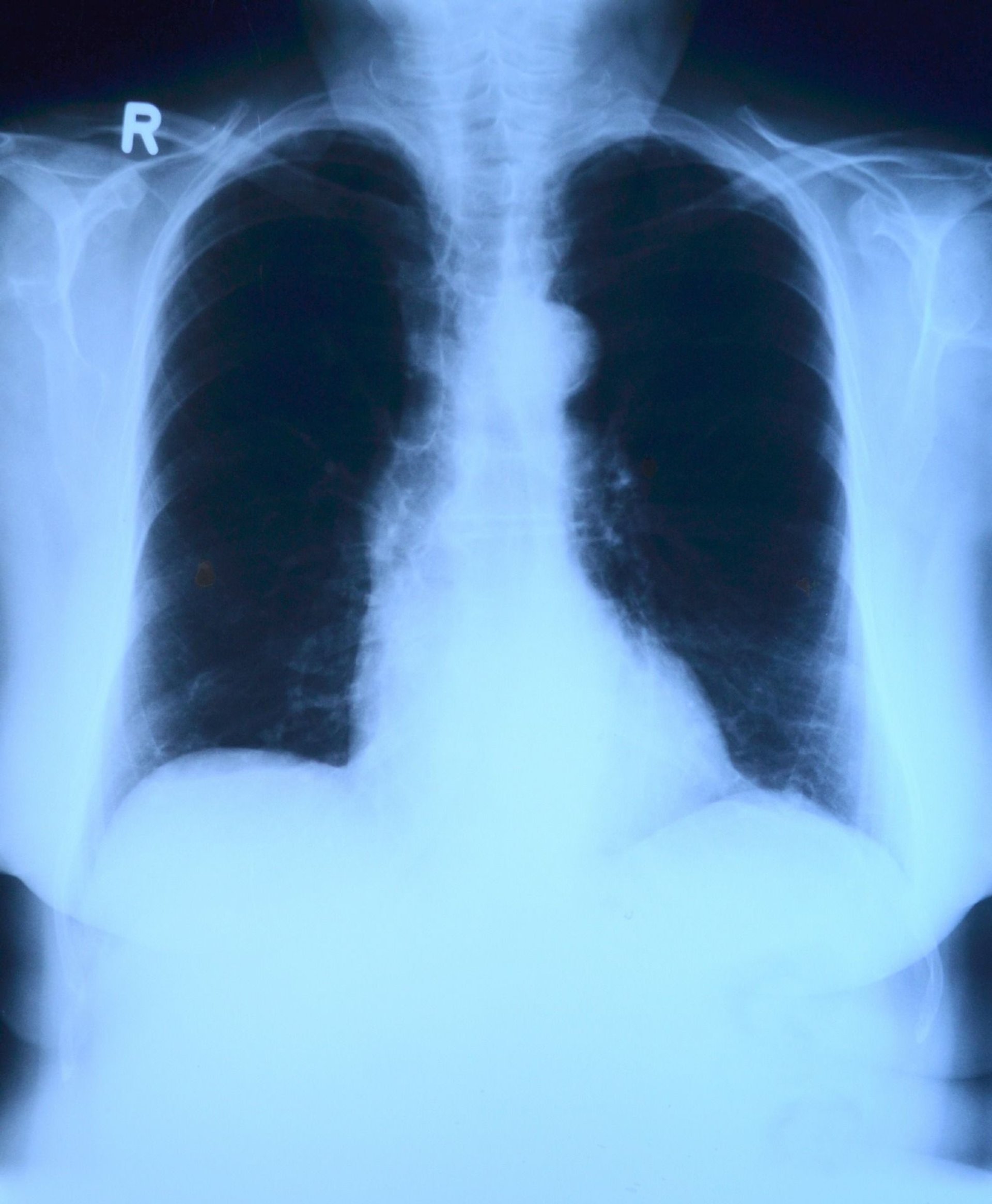 Pylica płuc – przyczyny, objawy, leczenie