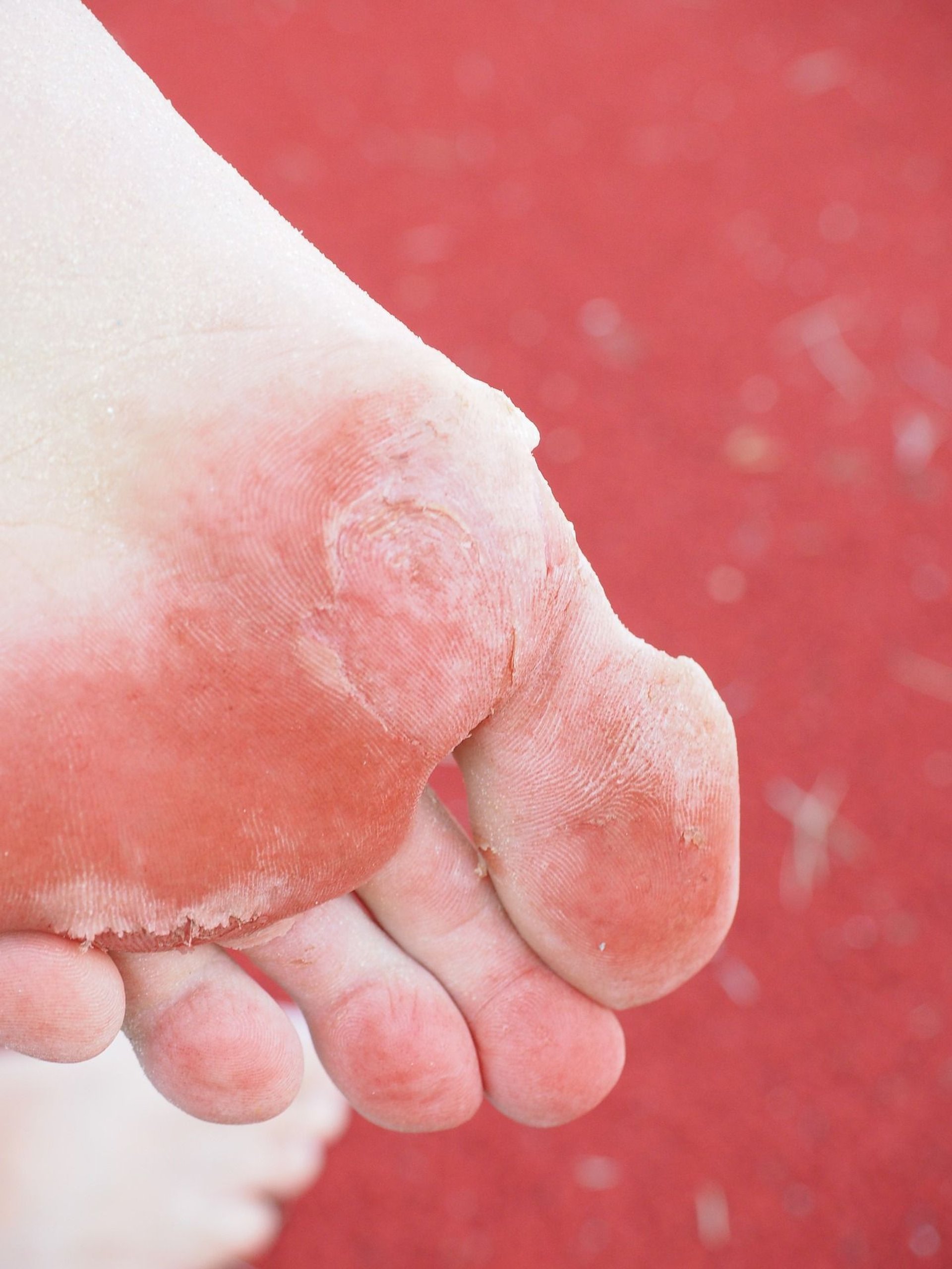 Grzybica stóp międzypalcowa wyprzeniowa – co to za infekcja?