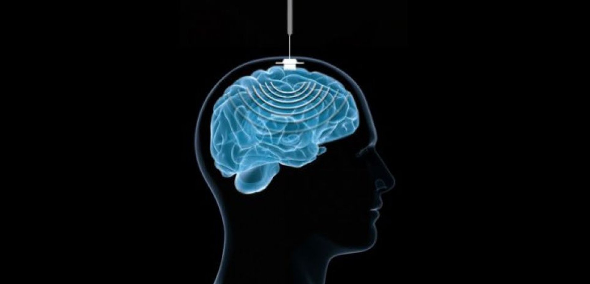 Grafika prezentująca wszczepienie implantu do mózgu.