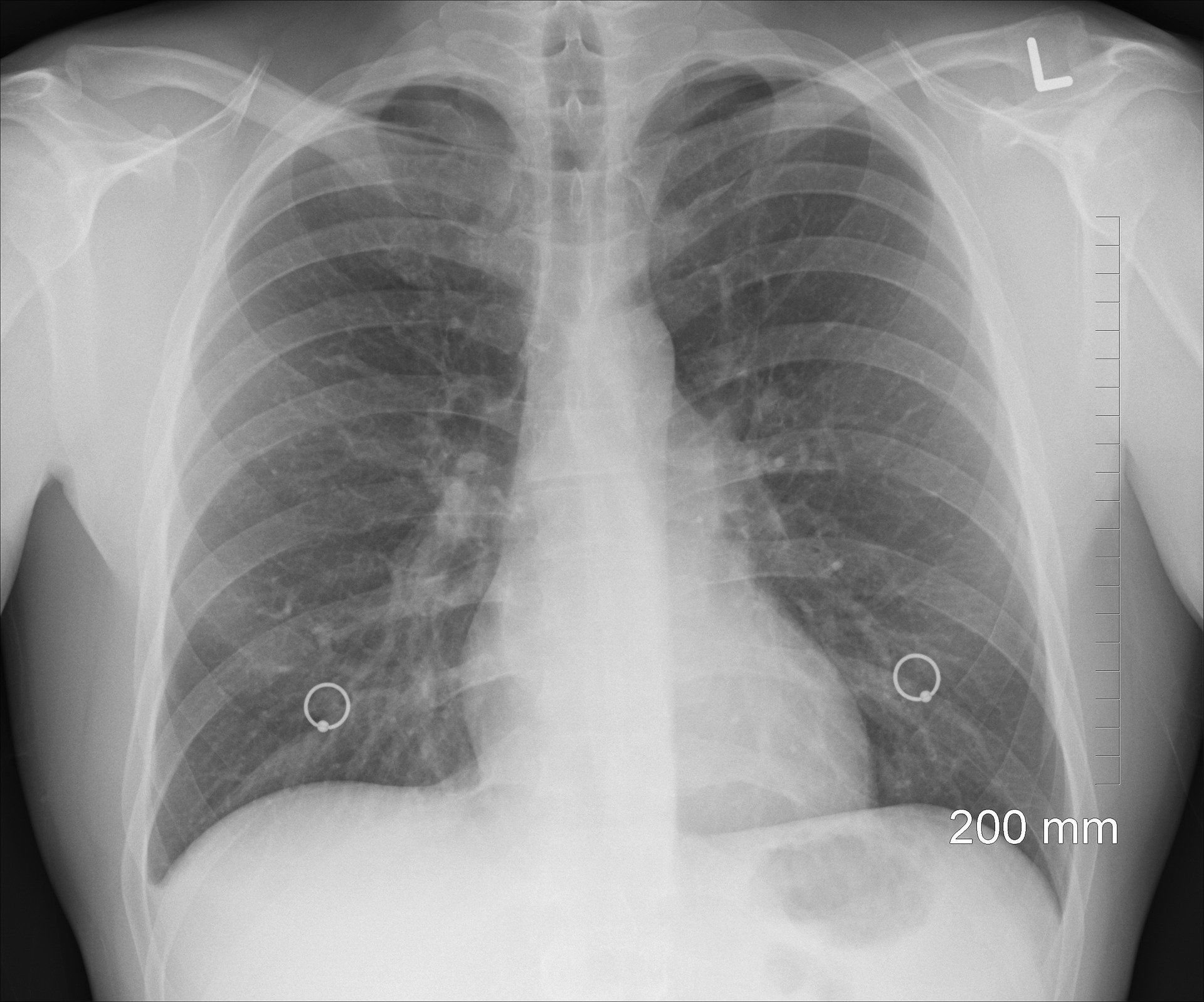 Rozedma płuc – przyczyny, objawy, rozpoznanie, leczenie