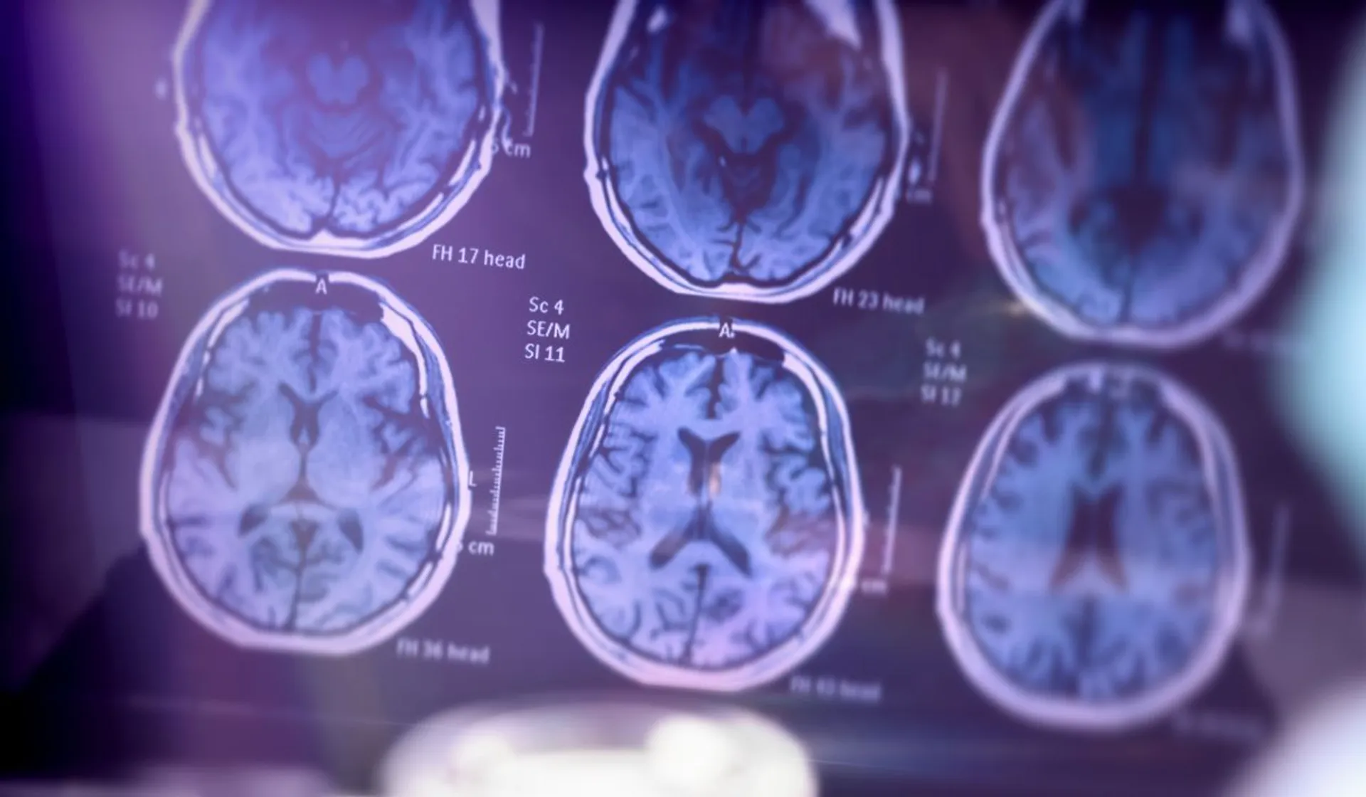 Coraz więcej przypadków alzheimera u młodych