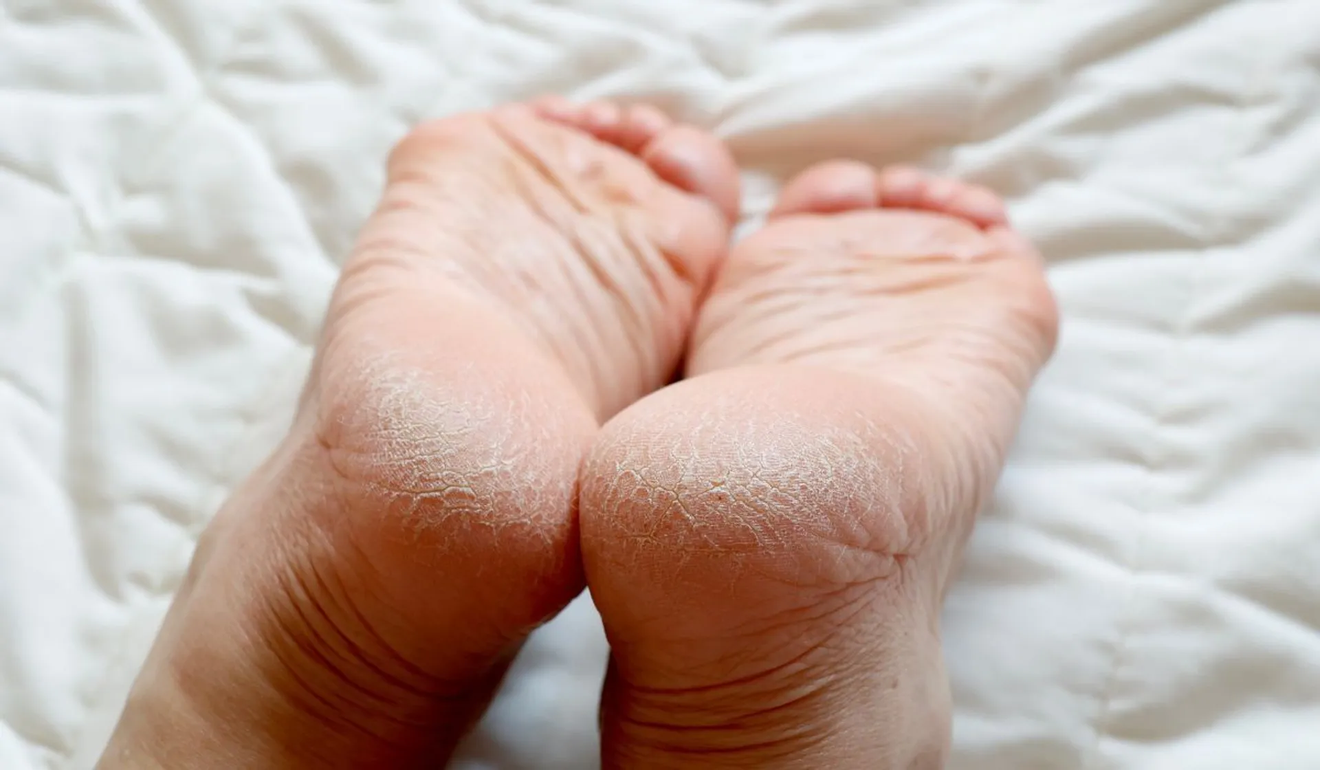 Sposoby na gładkie pięty – przyczyny pękania i domowa pielęgnacja olejami