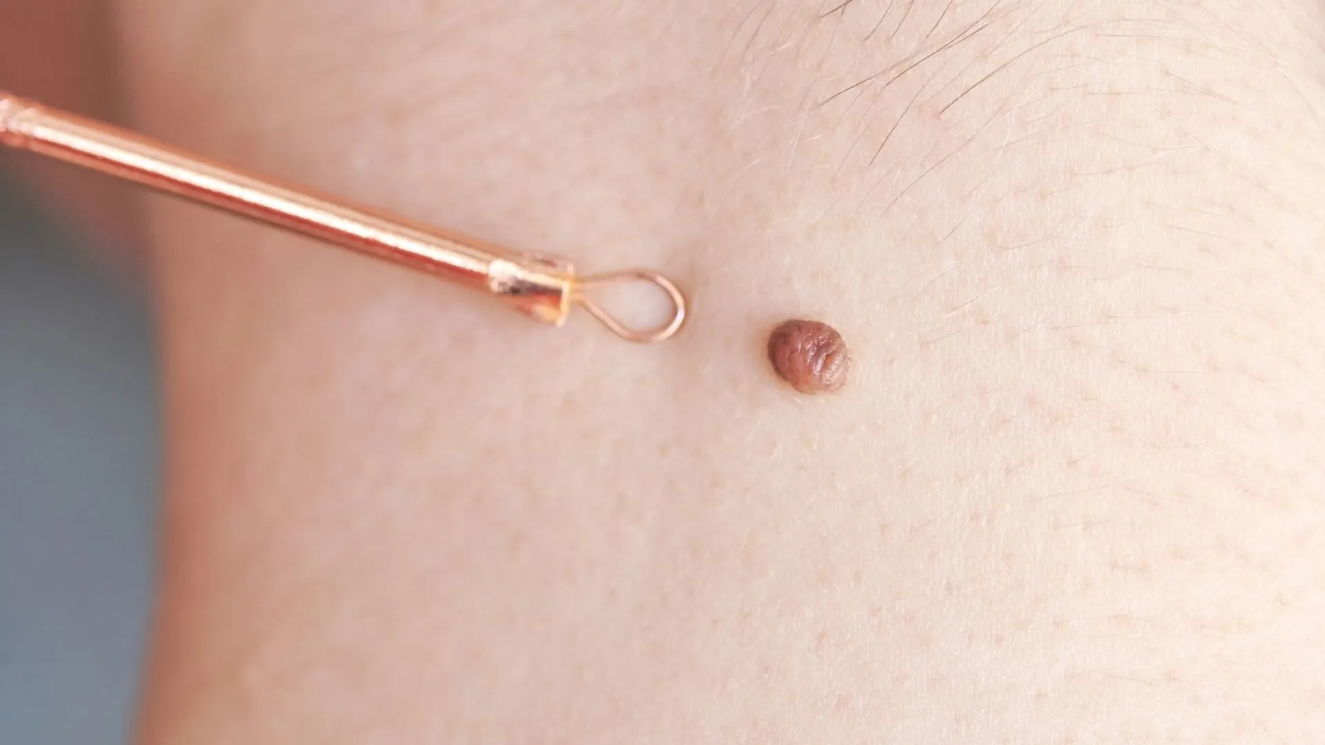 Włókniaki na skórze