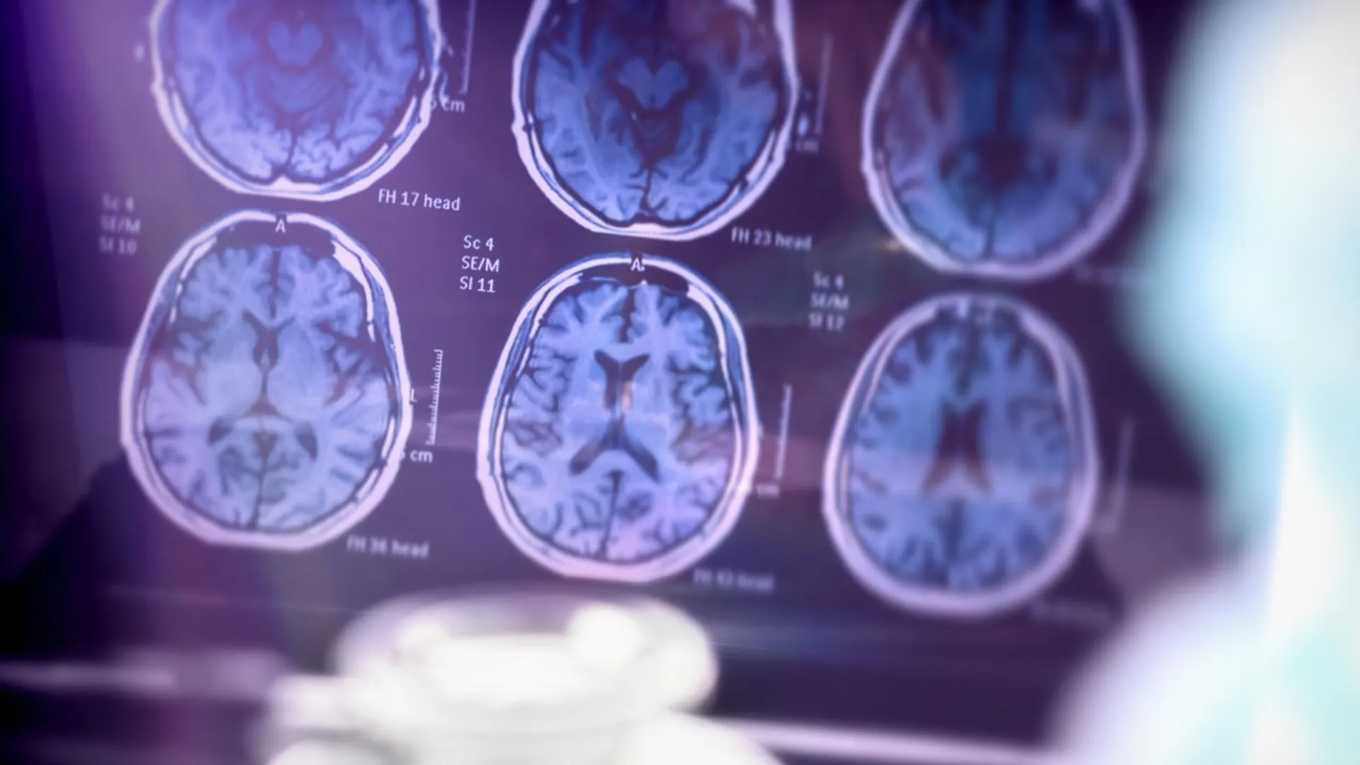 choroba Alzheimera