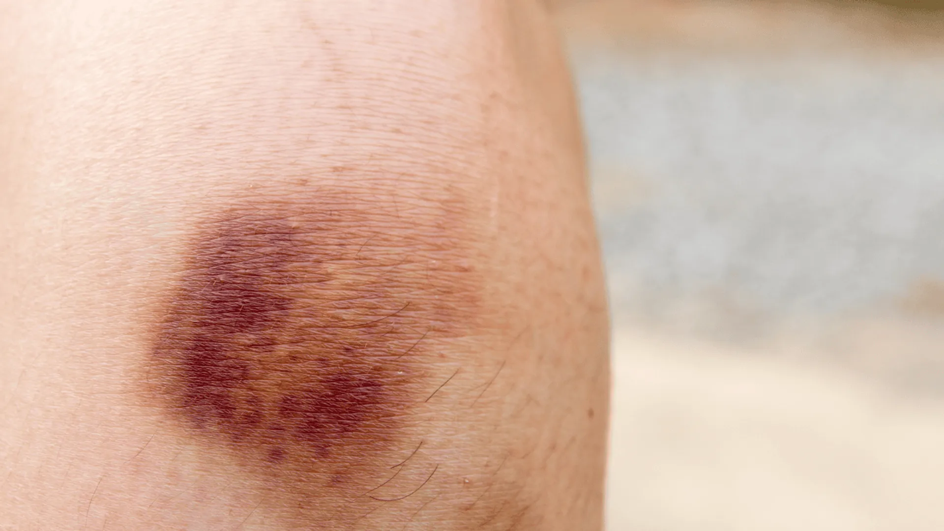 Małe czerwone plamki i siniaki: sygnał niedoboru witaminy K