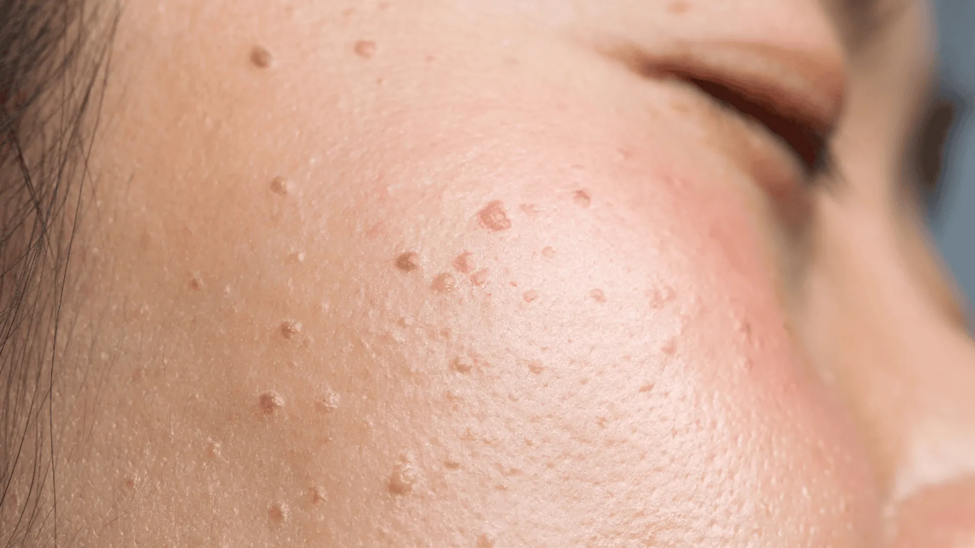 Objawy skórne raka żołądka