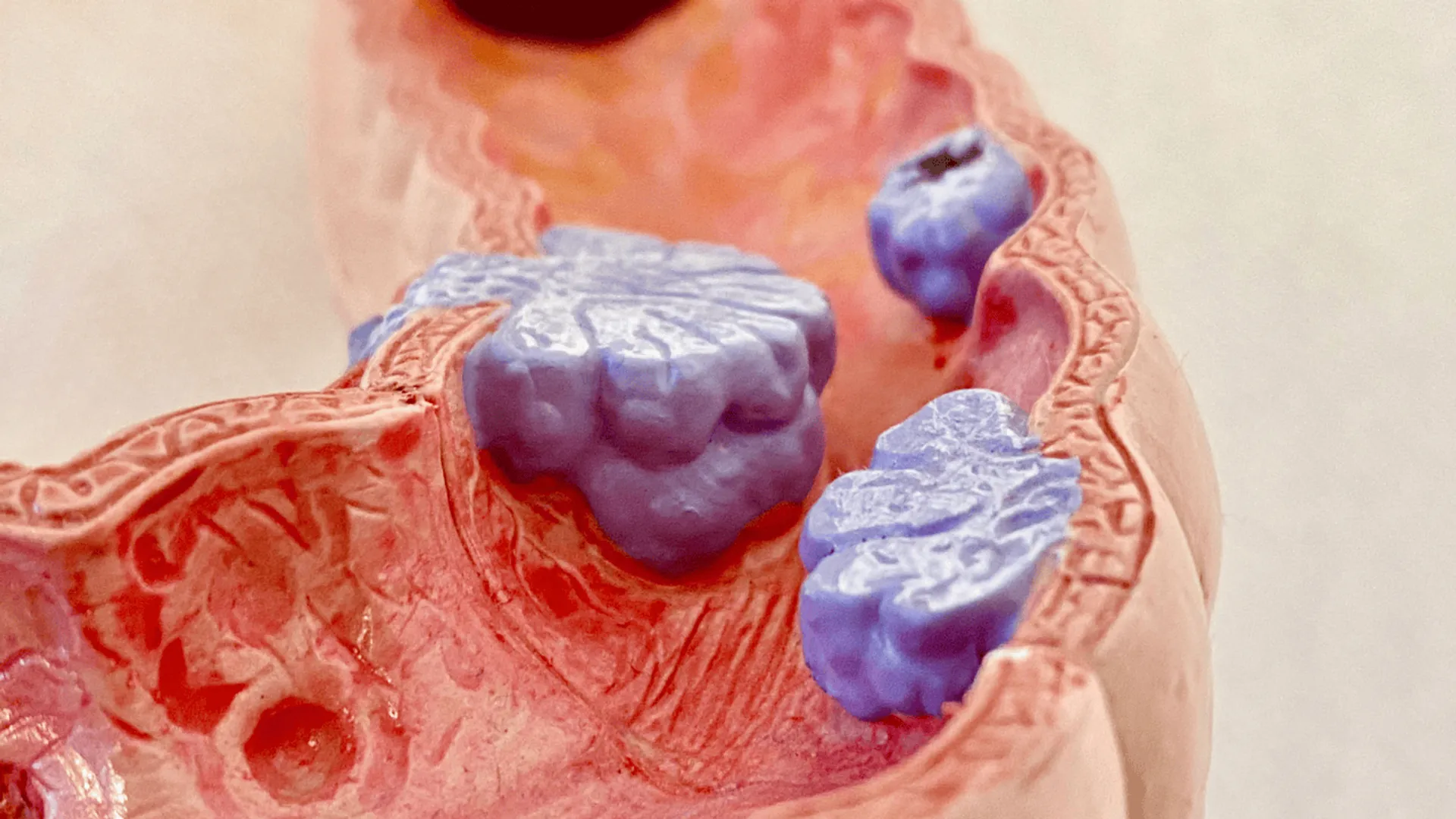 Rak jelita grubego: skala problemu, przyczyny i profilaktyka