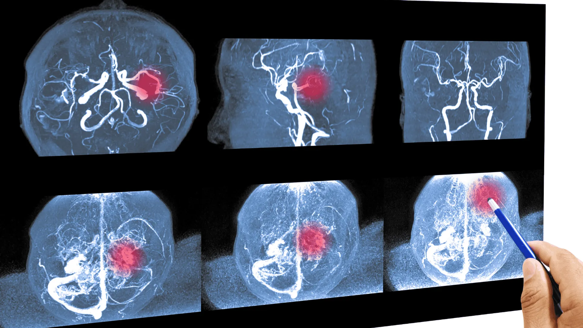 Tętniak - jak go rozpoznać?