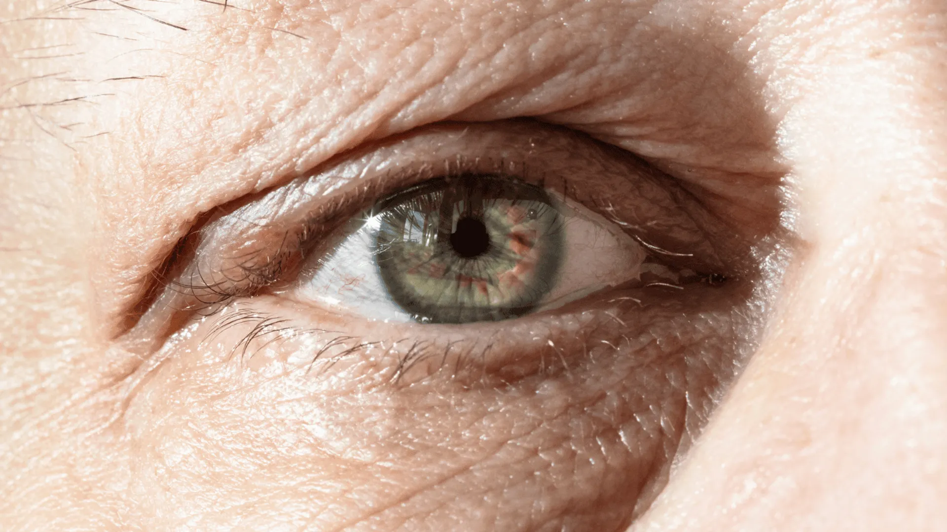 Wysoki poziom cholesterolu widać w oku