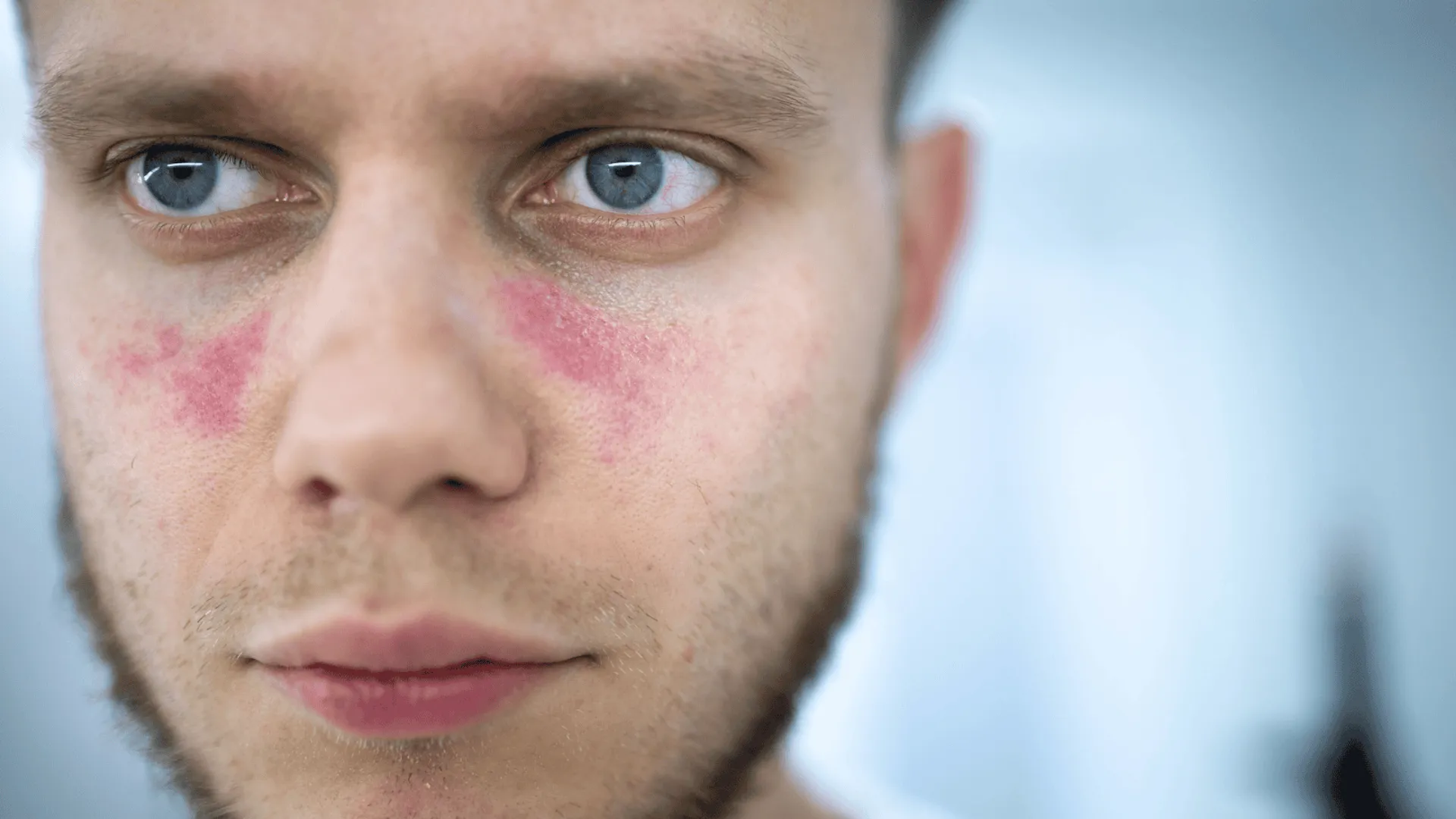 toczeń rumieniowaty