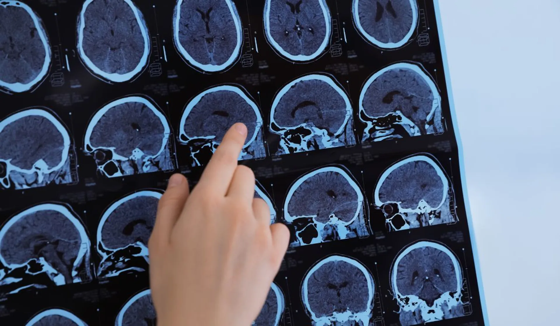 Udar mózgu u coraz młodszych osób