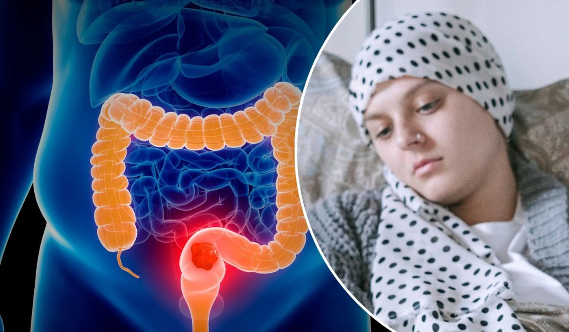 rak jelita u młodych