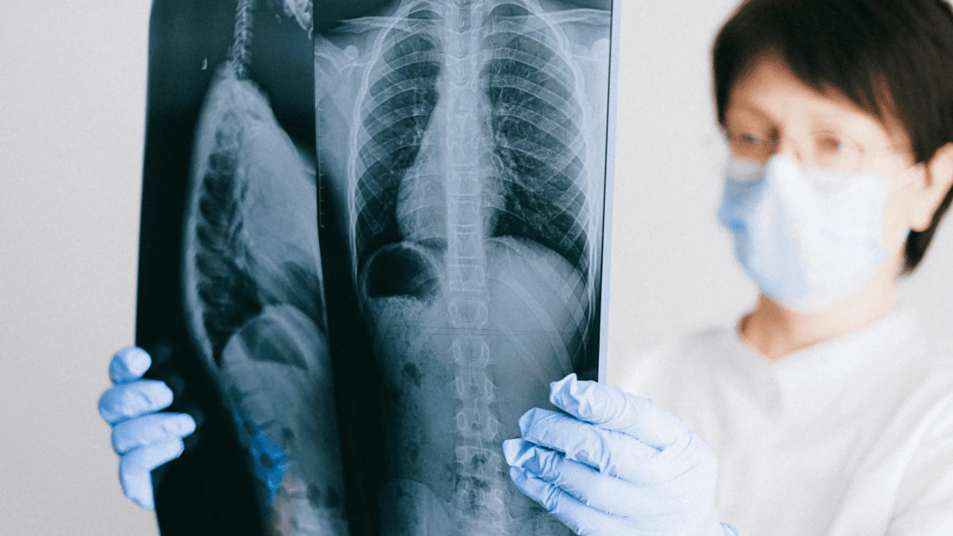 rak płuc diagnostyka rtg
