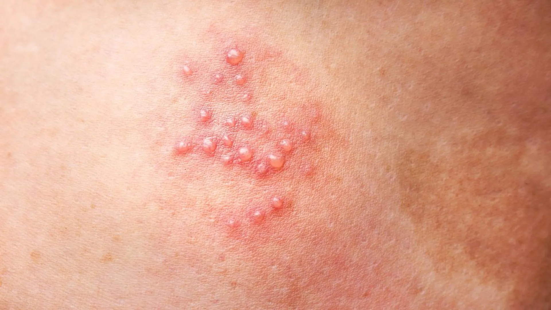 Półpasiec, którego powikłaniem jest ból utrzymujący się nawet wiele miesięcy po przechorowaniu 