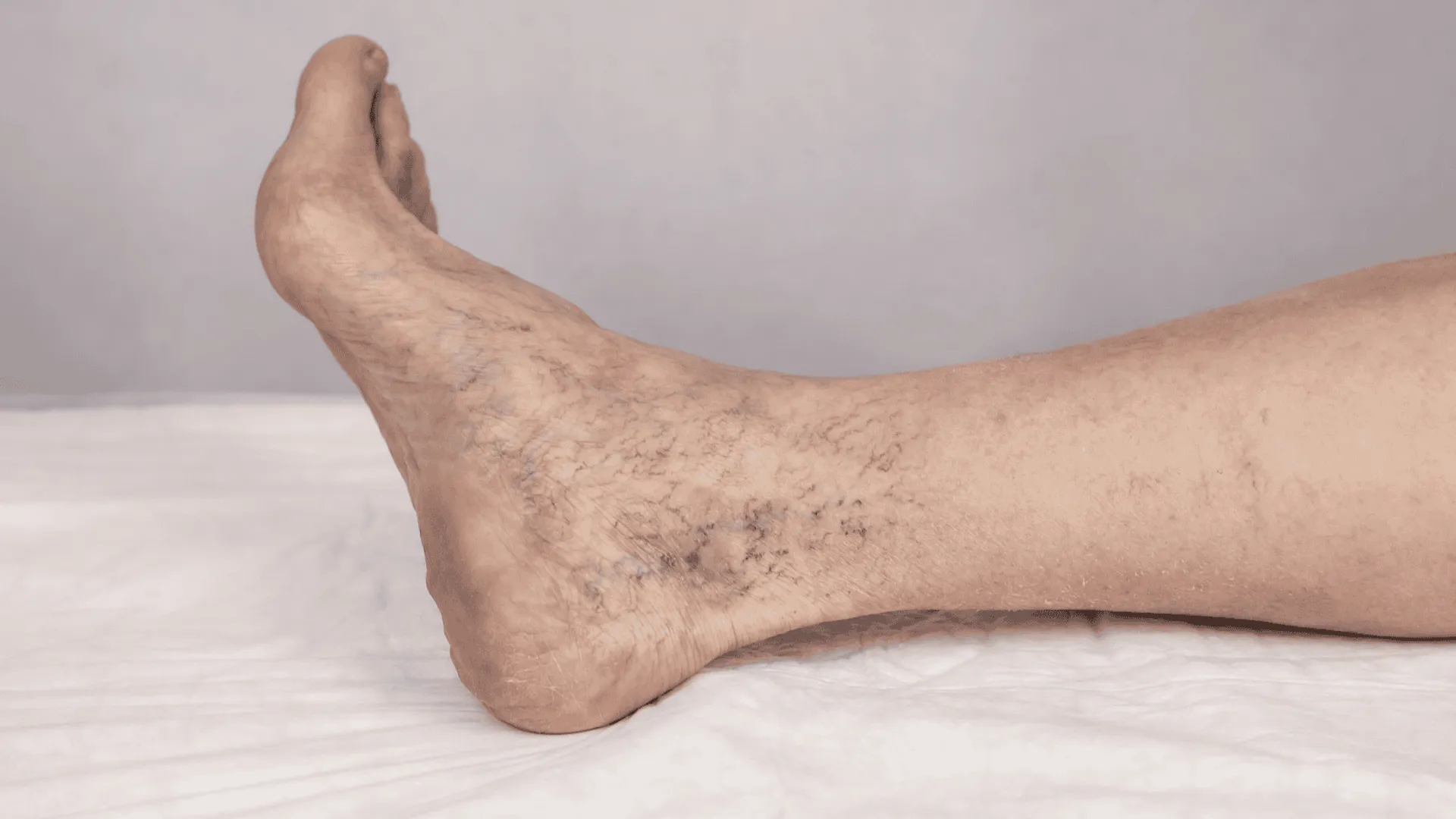 Zakrzepica żył głębokich: mechanizmy powstawania, objawy i zasady leczenia