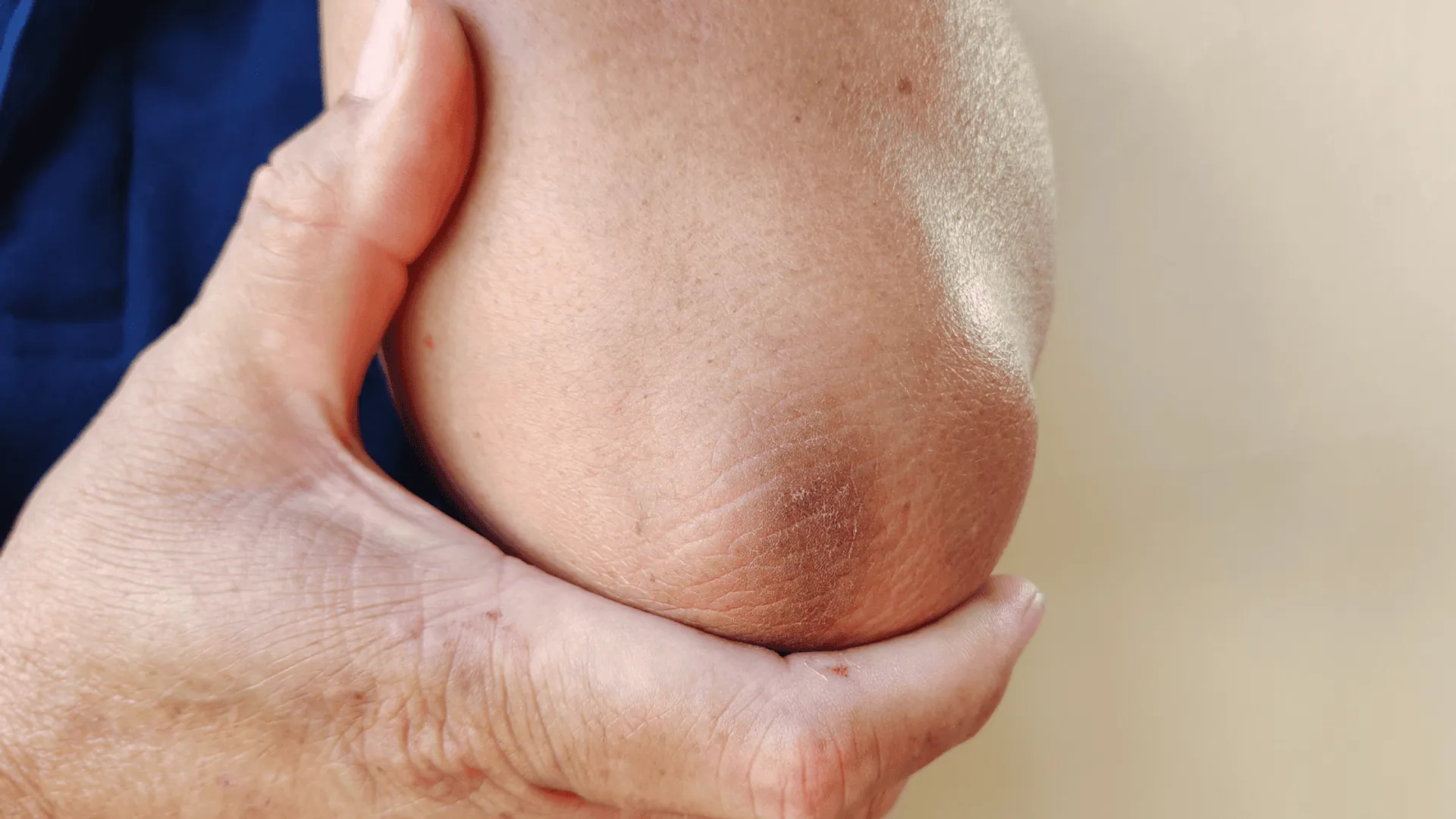 Przyczyny i znaczenie ciemnienia skóry na łokciach