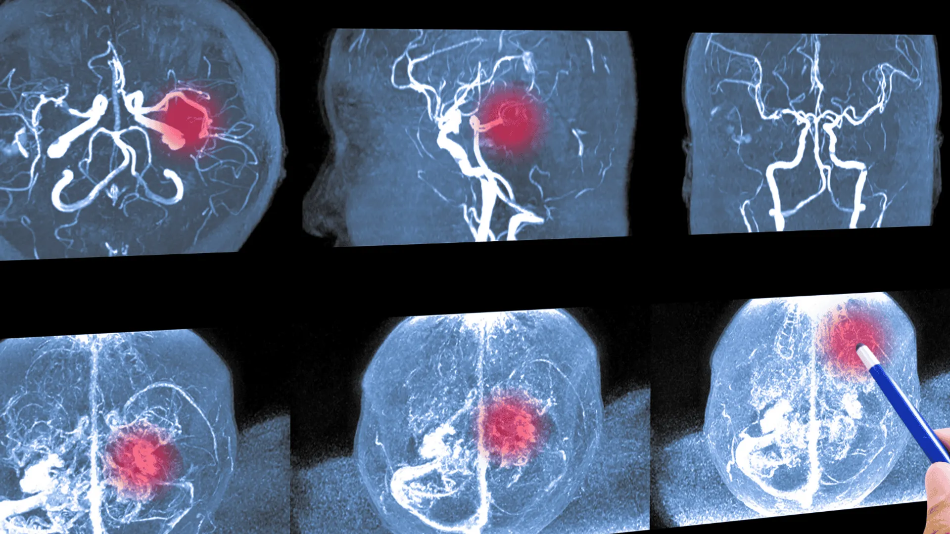 Cicha bomba z opóźnionym zapłonem – fakty o tętniaku mózgu