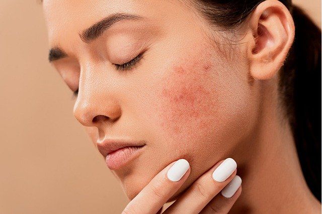 Infekcyjne zapalenie skóry - co warto wiedzieć?