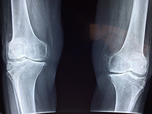 Ból kolan – przyczyny, diagnostyka, leczenie bólu w kolanach