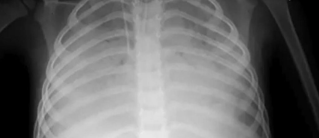 Zdjęcie rentgenowskie płuc