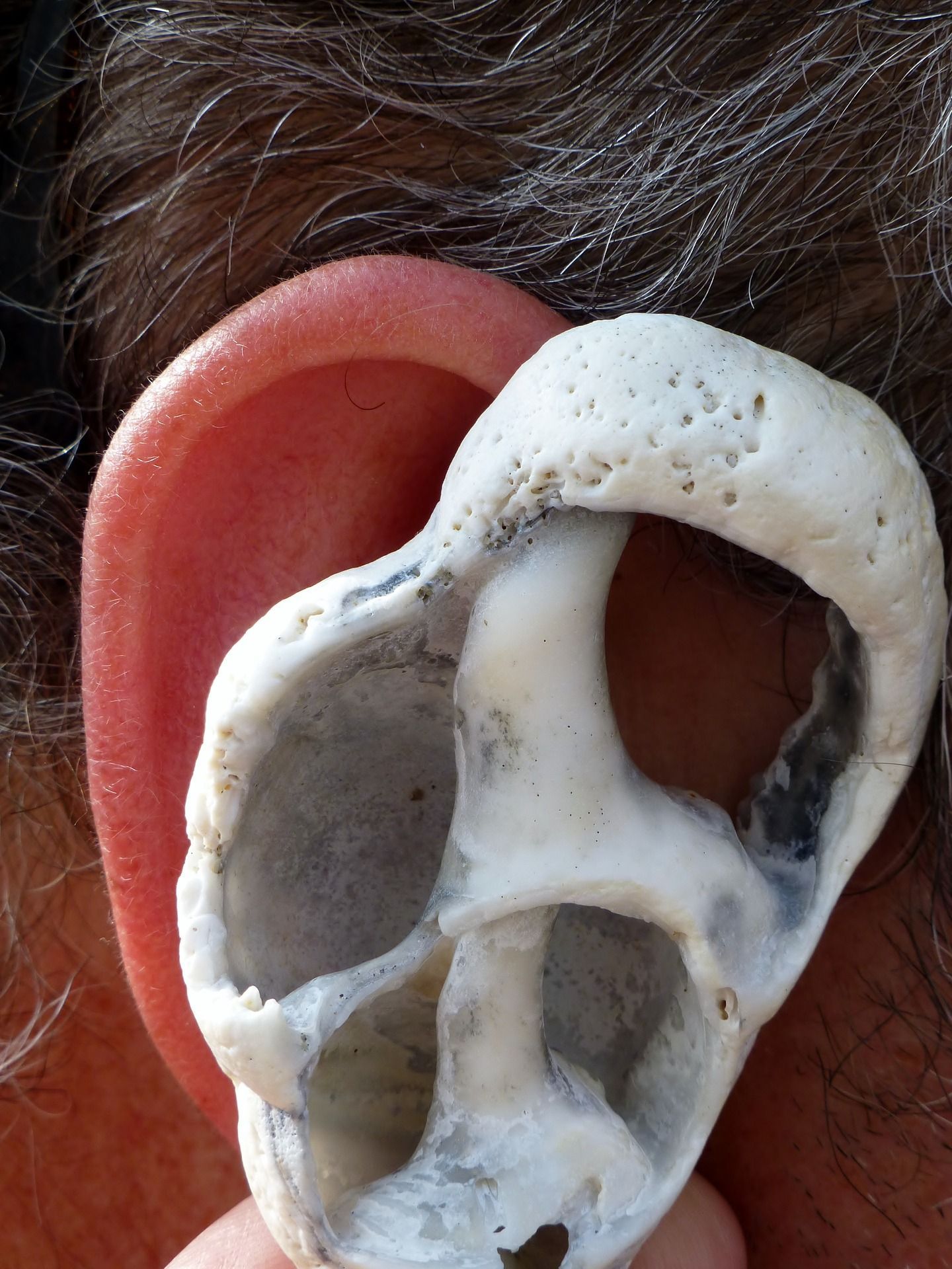 Otoskleroza ucha (otospongioza) – przyczyny, objawy, leczenie.