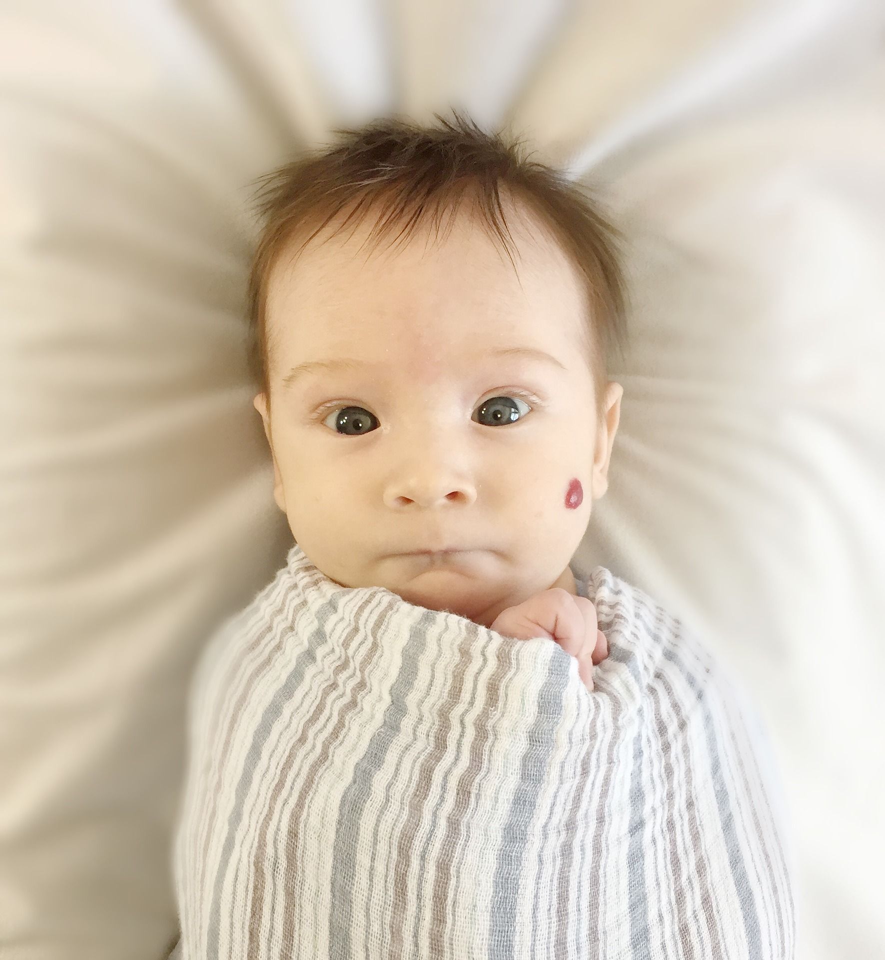 Naczyniak okresu niemowlęcego – przyczyny powstawania i leczenie naczyniaków u niemowląt