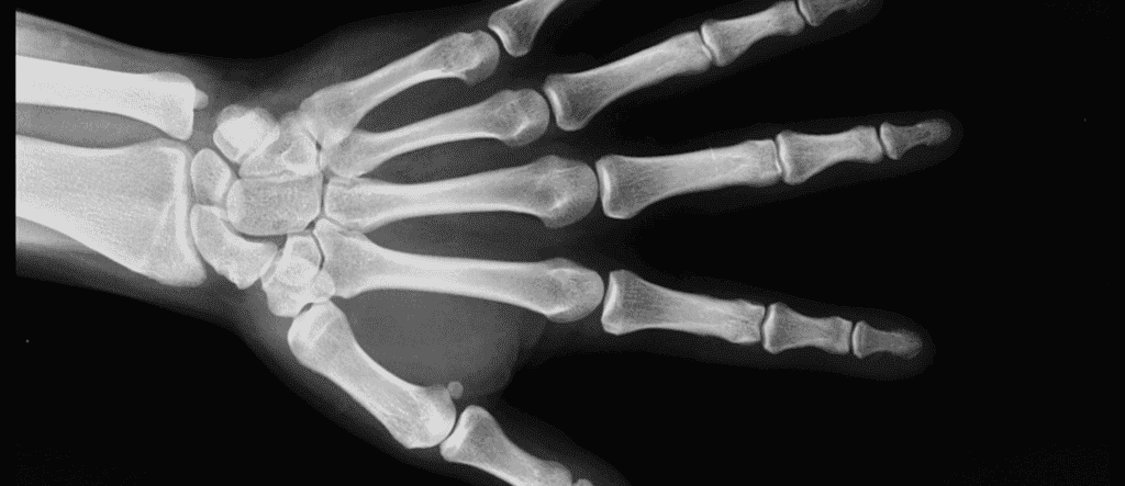 rentgen ręki
