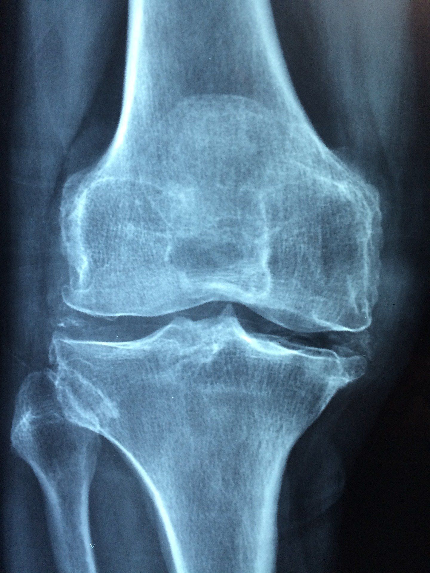 Osteoporoza – przyczyny, objawy, leczenie.