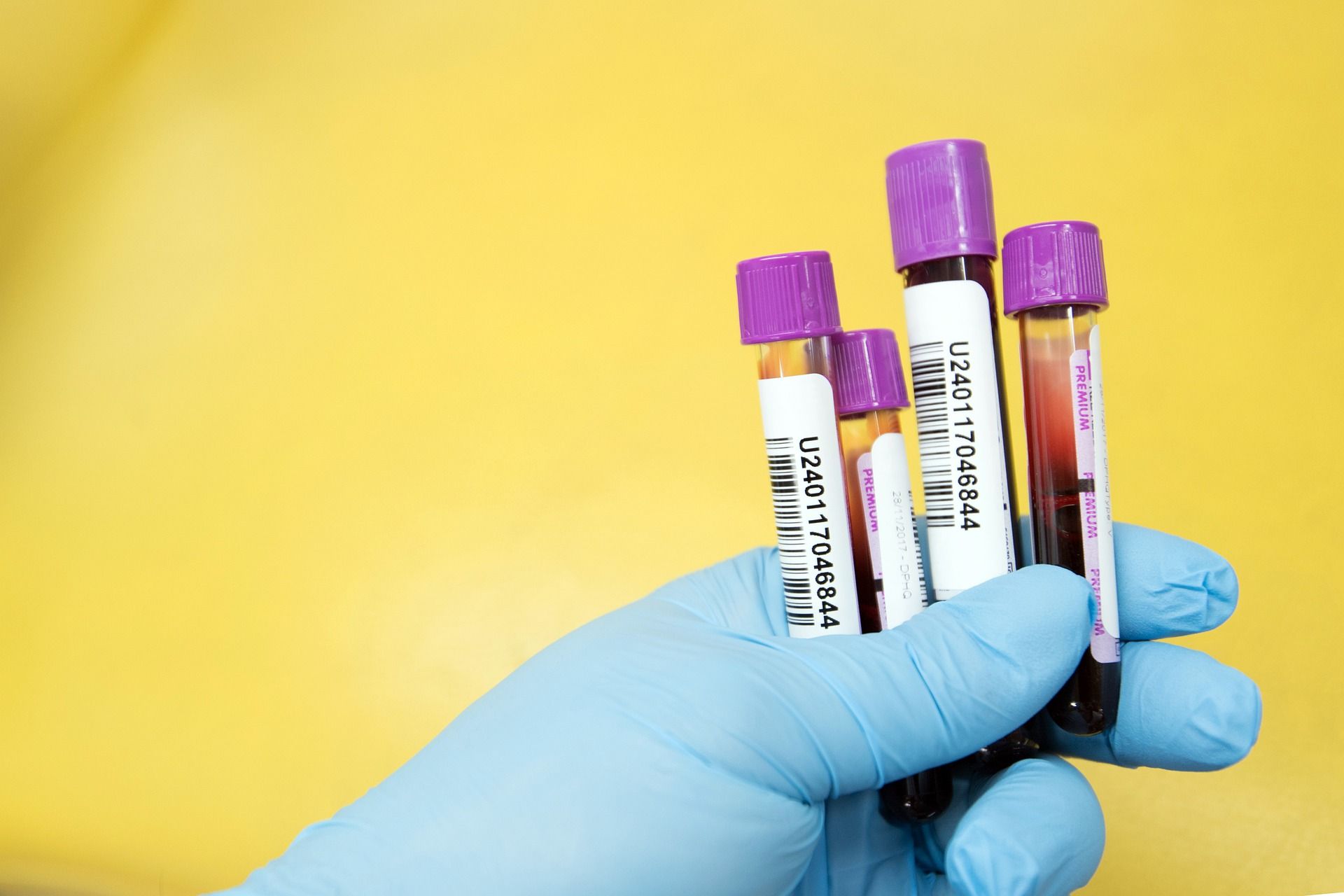 Hemoglobina glikowana (HbA1C) – badanie, normy, znaczenie wyniku