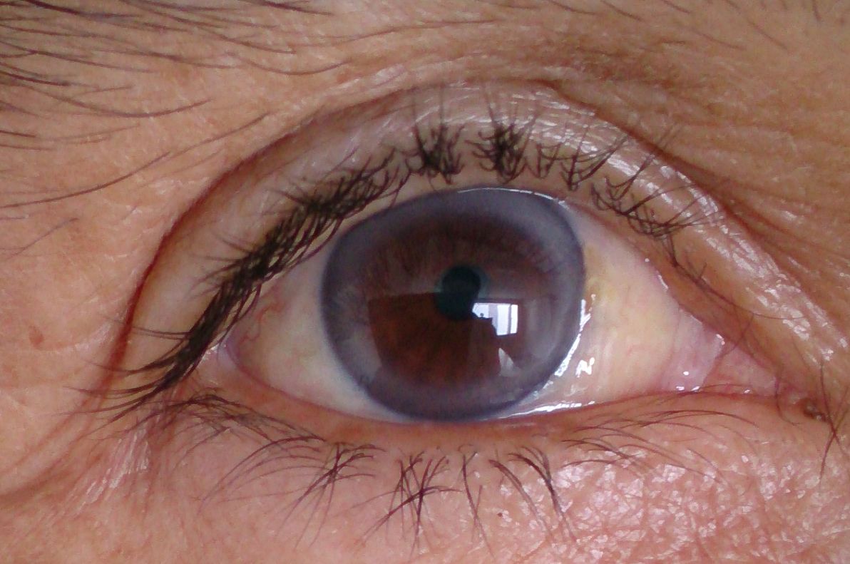 Nietypowy objaw wysokiego cholesterolu, który widać gołym okiem. Zwróć uwagę na źrenice