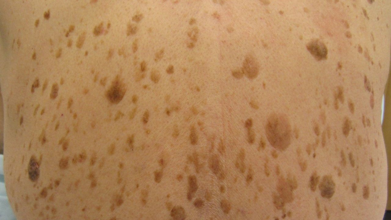 Gdy zaczyna się rak żołądka, zmienia się skóra. Jeśli zauważysz takie zmiany, biegnij do lekarza