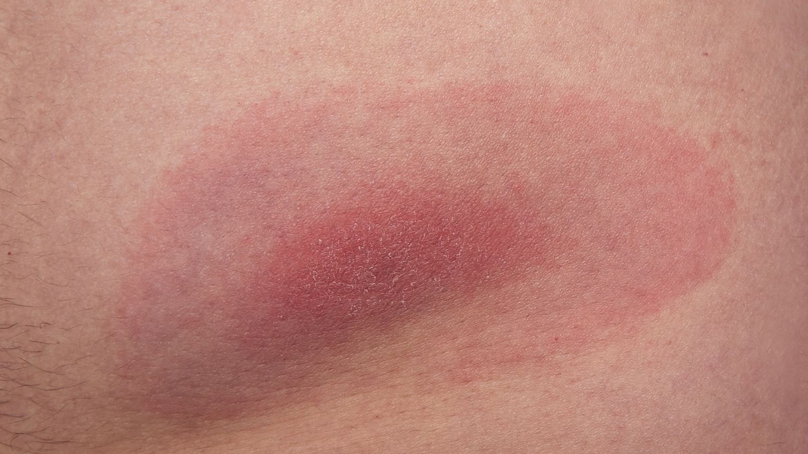 W Polsce już się zaczęło. Trzeba uważać na spacerach, w ostatnich latach to prawdziwa plaga