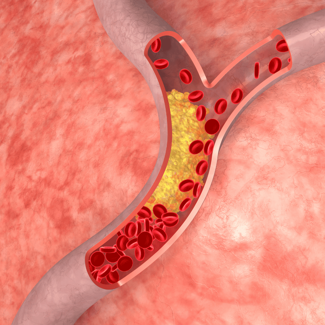 Działa na cholesterol jak potężna miotła. Zjedz jedną łyżkę rano, a twoje tętnice odetchną z ulgą