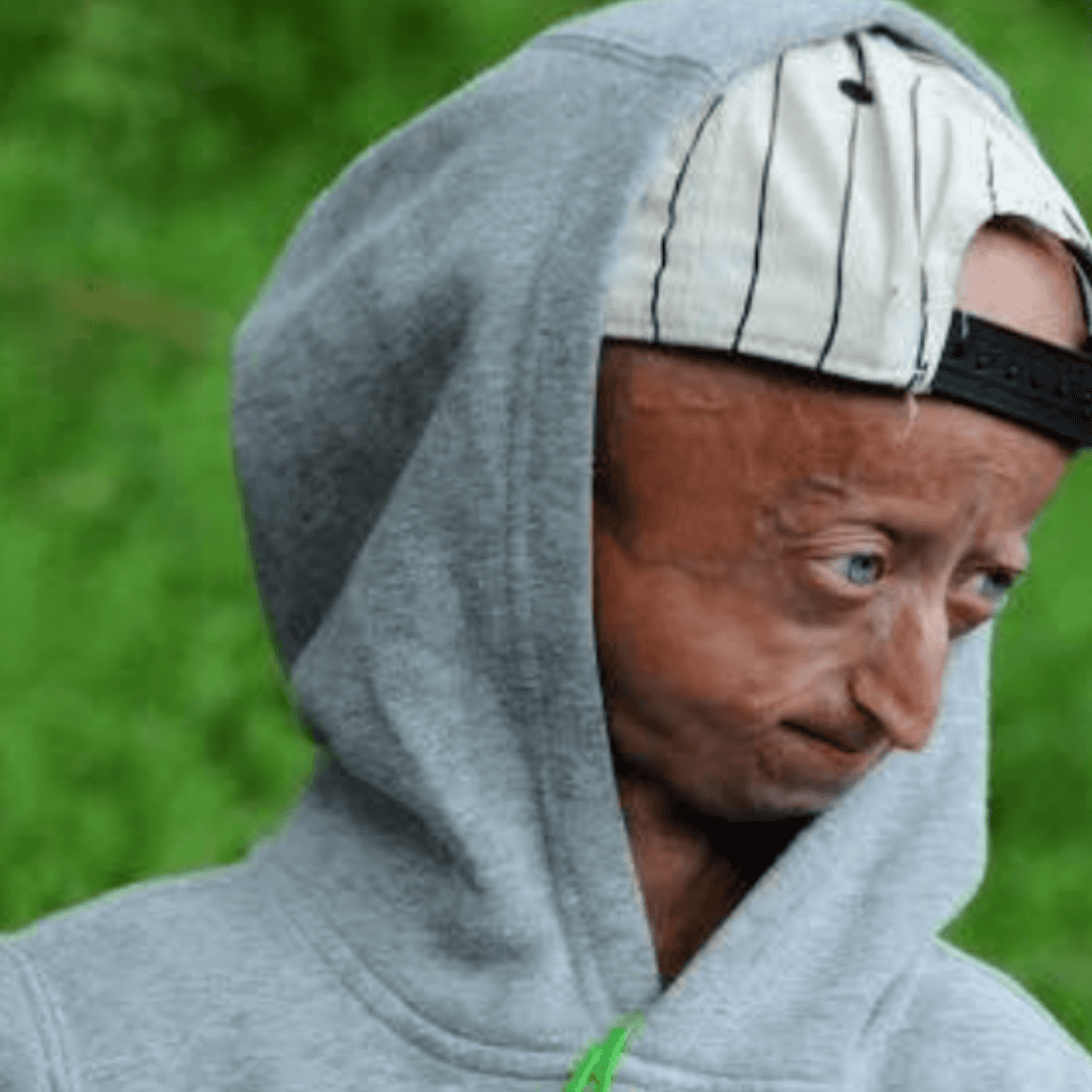Nie żyje Michiel Vandeweert. Dawano mu 12 lat życia, dożył 28