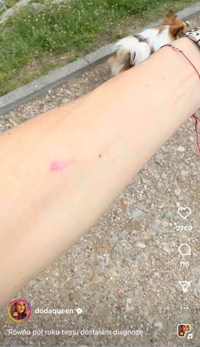 Doda pokazała bliznę po wycięciu nowotworu. Tak wygląda jej ciało po walce z czerniakiem