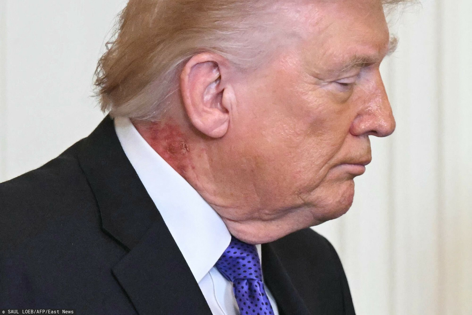 Niepokojące, co dzieje się ze zdrowiem Trumpa. Cały świat patrzy tylko na to