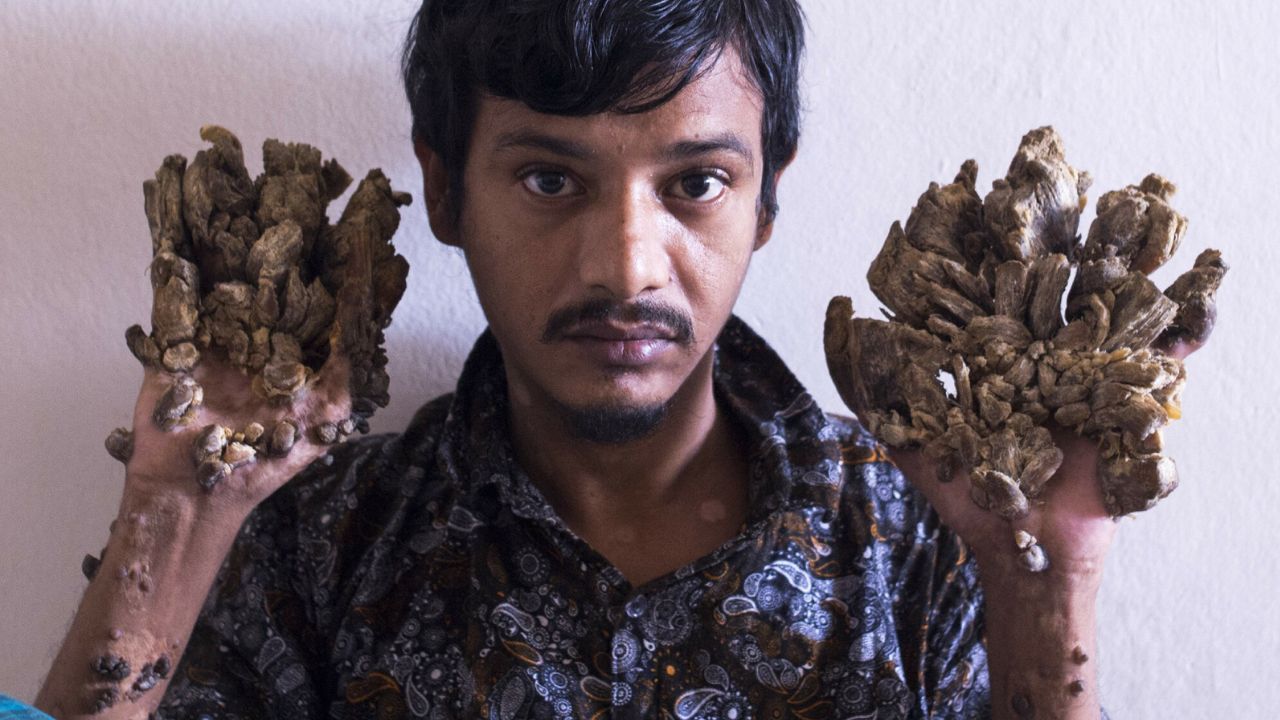 tree man Fot. MUNIR UZ ZAMAN/AFP/East News.jpg