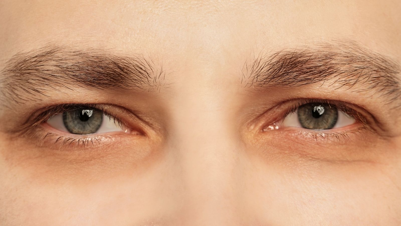 Worki pod oczami to nie tylko problem estetyczny. Mogą sygnalizować poważną chorobę