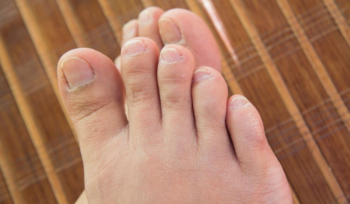 Palce u stóp mogą wskazać poziom cholesterolu