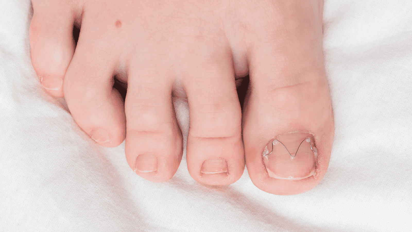 Pierwsze objawy grzybicy paznokci. Ten jeden sygnał pojawia się najwcześniej