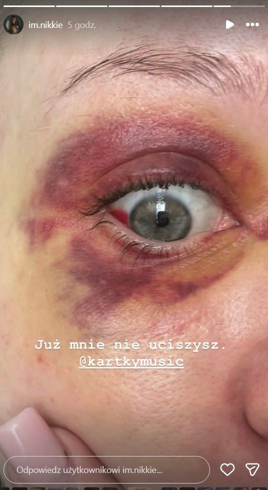 Horror partnerki polskiego rapera. Katował ją za zamkniętymi drzwiami. To nie wszystko