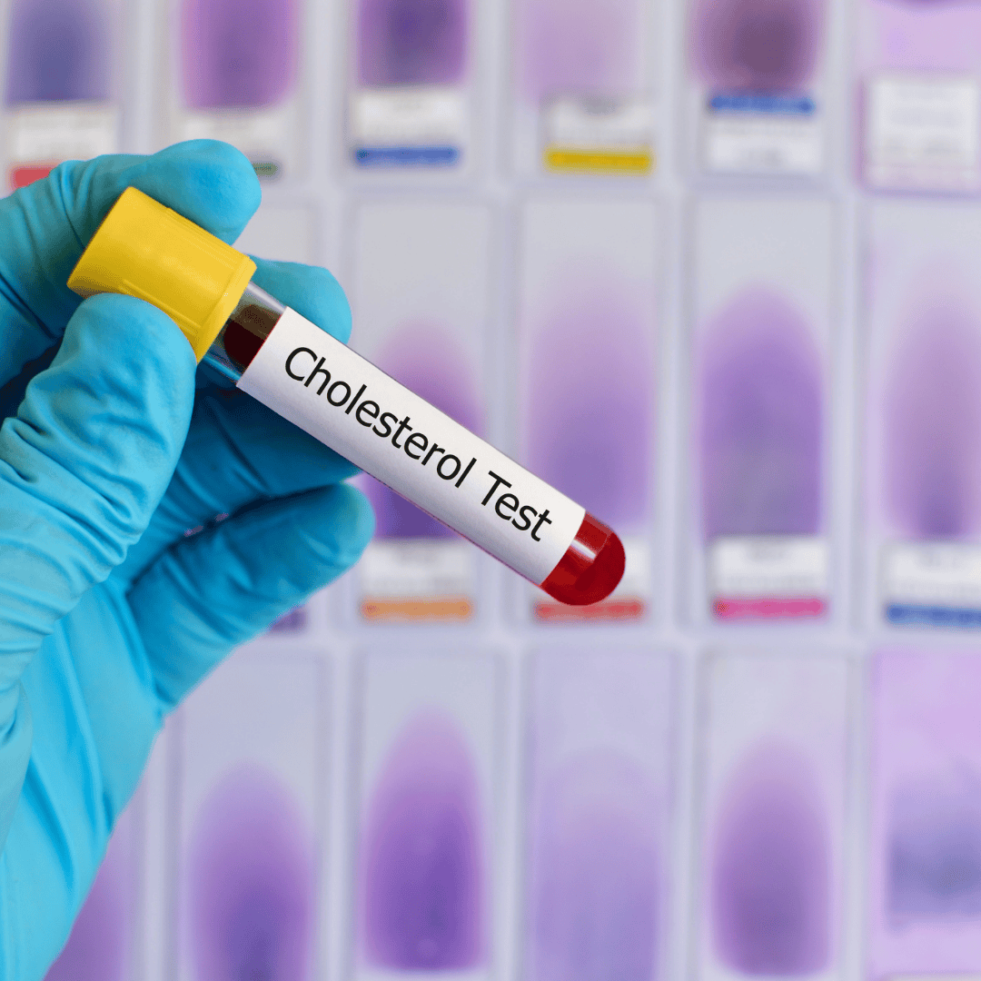 Nowe normy cholesterolu LDL. Eksperci zaostrzają wytyczne