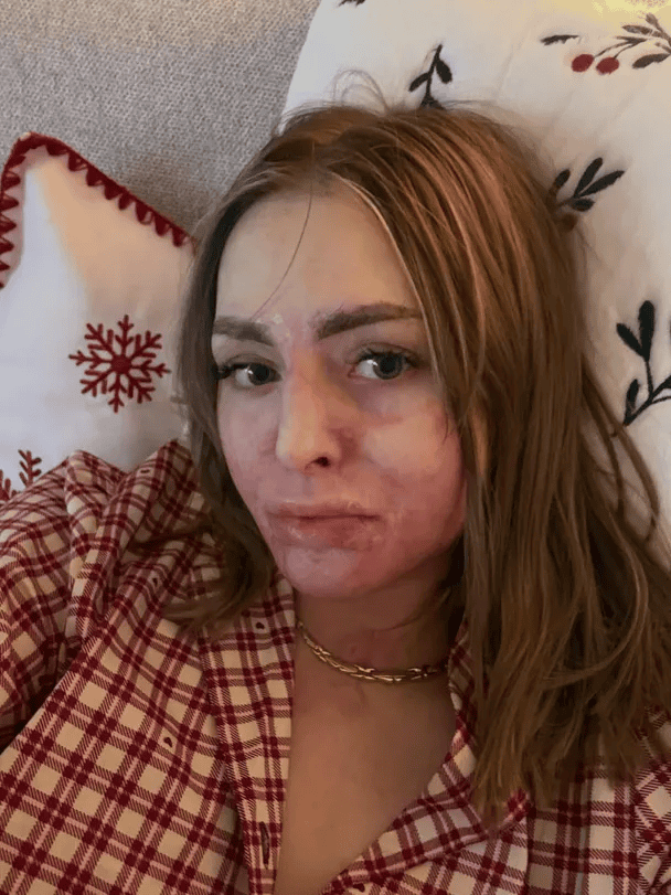 Po pożarze z trudem uszła z życiem. Niebywałe, z czym teraz musi się mierzyć. Koszmar gwiazdy sieci trwa