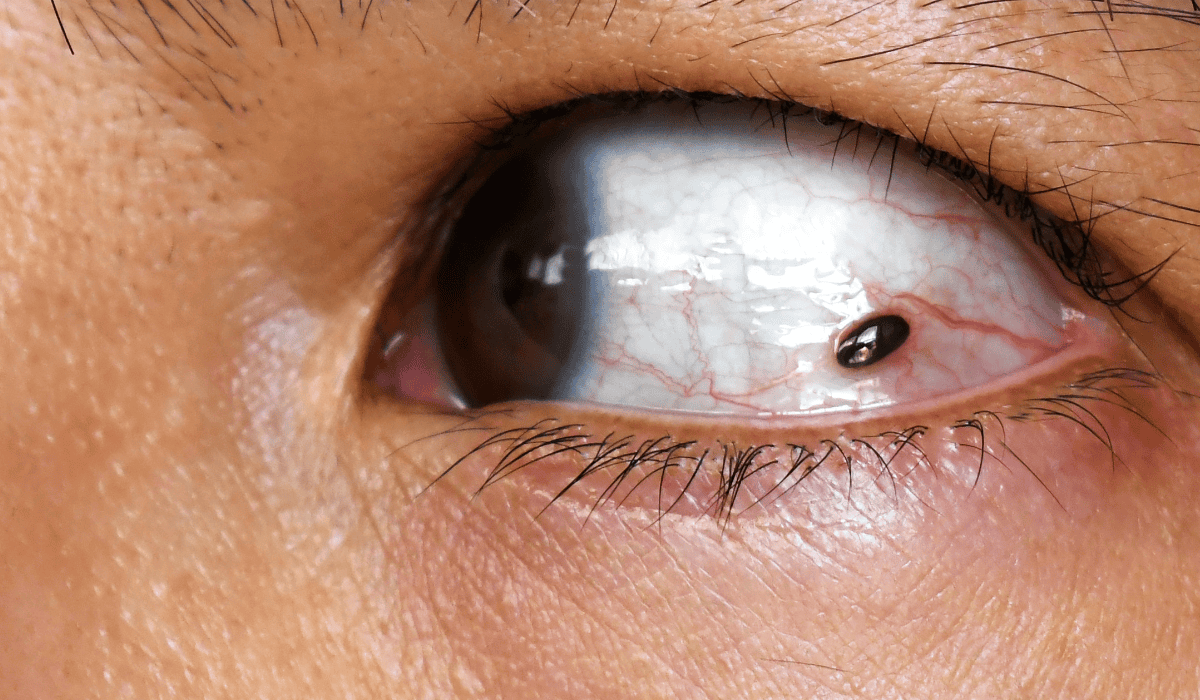 Suchość oczu, zamglenie i leczenie miesiącami. To może być nowotwór