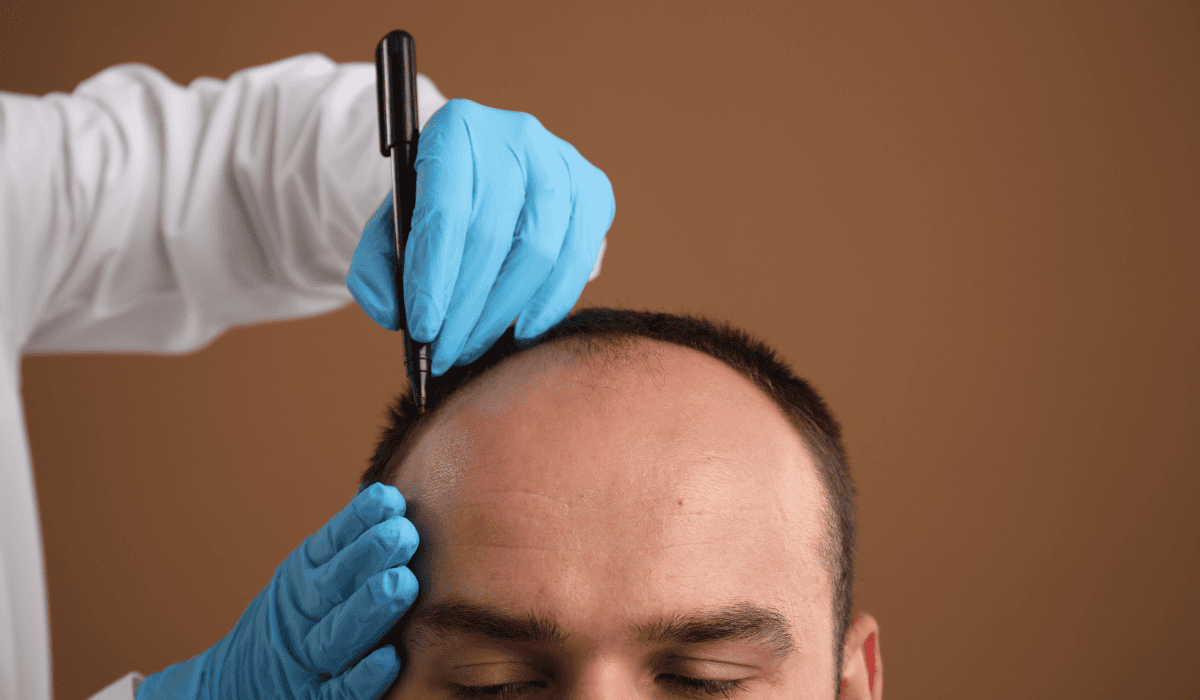 To trzeba sprawdzić przed przeszczepem włosów w Turcji. Obowiązkowo