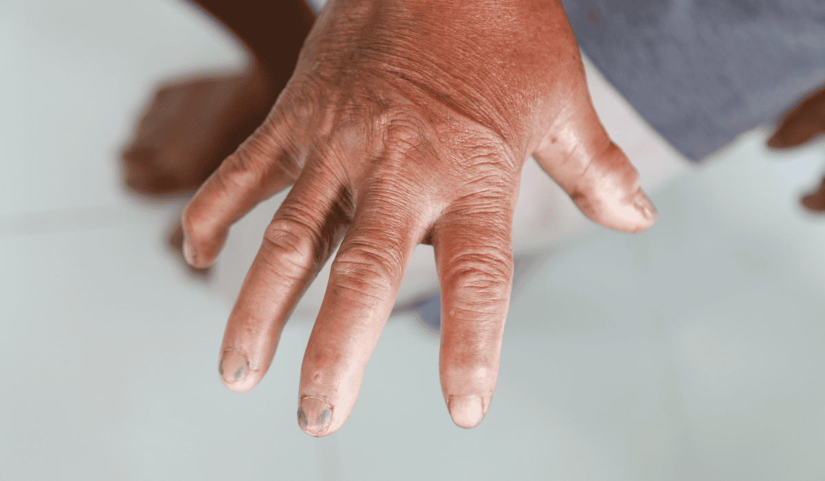 Rewolucja w terapii autoimmunologicznej. Gliwice jako pierwsze na świecie podały CAR-T na twardzinę