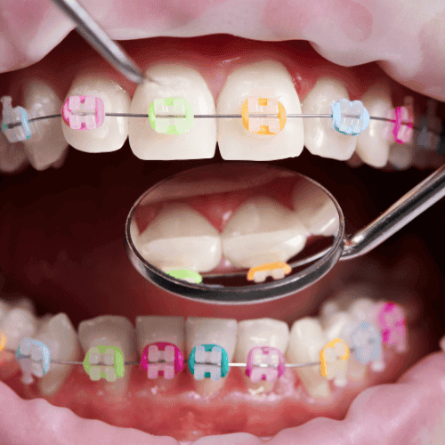 Rewolucja w ortodoncji na NFZ? Zmiany mają pomóc starszym dzieciom