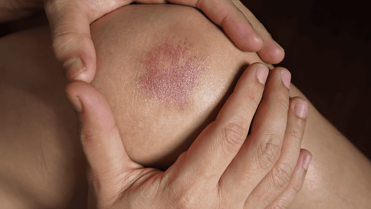 Małe czerwone plamki i siniaki. To znak, że brakuje ci tej witaminy